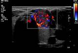 Background thyroid nodules are very common. Colour Doppler image of malignant thyroid nodule show ...