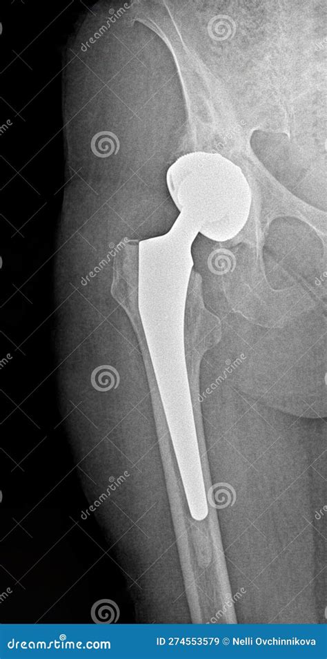 X Ray Image Of The Hip Joint Of A 57 Year Old Woman Condition After
