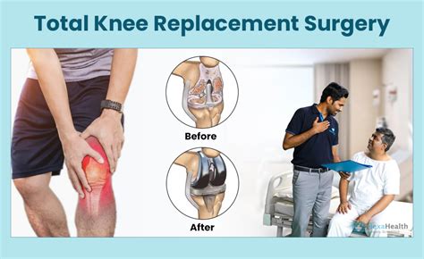 Total Knee Replacement Surgery Procedure And Side Effects
