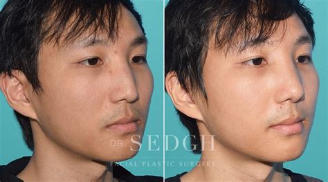 Male Rhinoplasty Before And After Photos Dr Sedgh