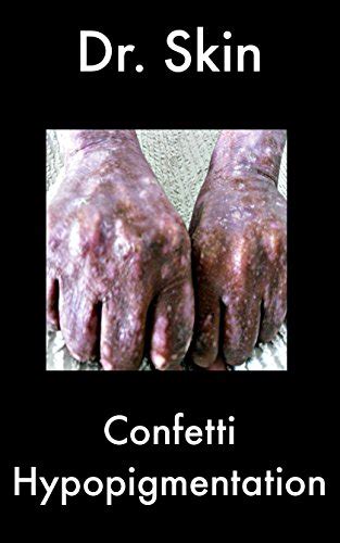 Confetti Hypopigmentation Ebook Skin Dr Kindle Store