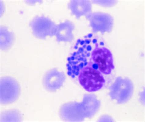 Giant Cytoplasmic Granules In Neutrophils Pathognomonic Of