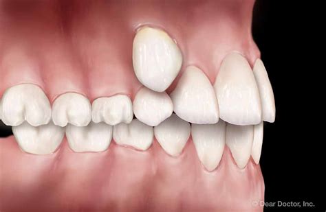 Common Orthodontic Problems Jeff Thompson Orthodontics Leawood Kansas