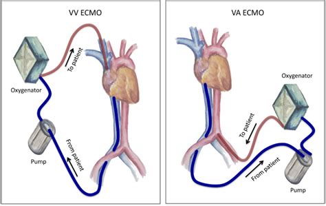 Extracorporeal Membrane Oxygenation During Adult Noncardiac Surgery And