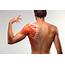 Muscle Strains Treatment In Fairfax VA  SAPNA Spine And Pain Clinic