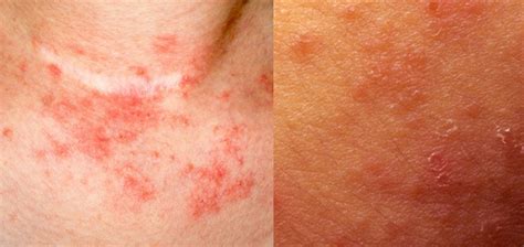 Signs Of Eczema Dorothee Padraig South West Skin Health Care