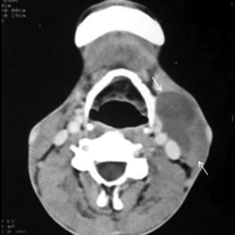 Pdf Cystic Masses Of Neck A Pictorial Review