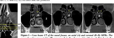 Figure 3 From Variant Anatomy Of Nasal Turbinates Supreme Superior