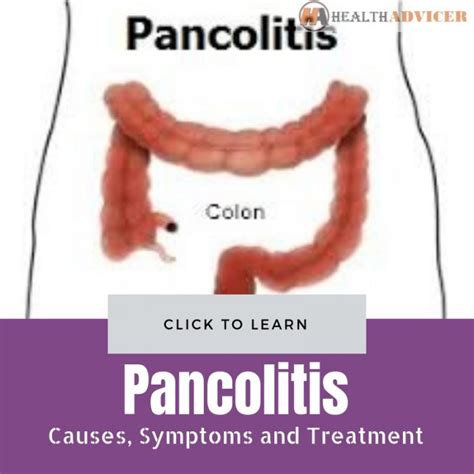 Pancolitis Causes Picture Symptoms And Treatment