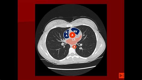How To Read A Chest Ct Scan With Contrast