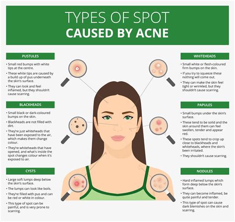 Understanding The Causes Of Acne Ask The Nurse Expert