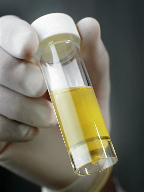 Urine Sample Photograph By Saturn Stillsscience Photo Library Pixels
