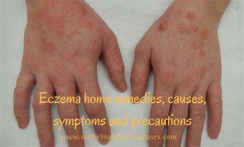 Home Remedies For Eczema Causes Symptoms And Precautions