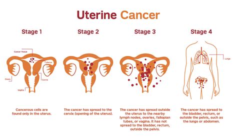 Endometrial And Uterine Cancers Patient Care