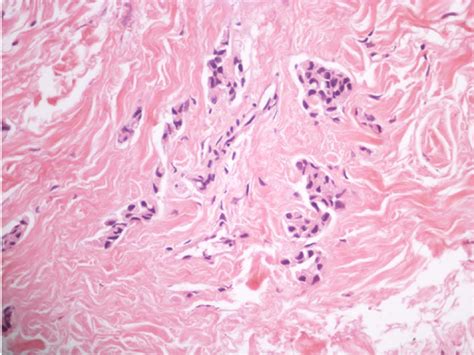Scielo Brasil Primary Ductal Carcinoma Of Ectopic Breast Primary