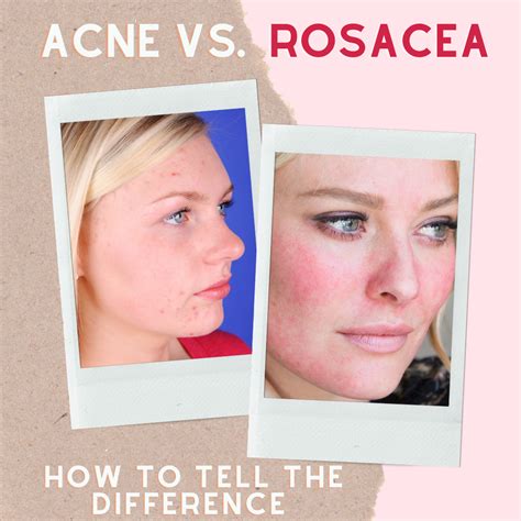 Acne Vs Rosacea Rosacea Symptoms Rosacea Skin Care Organic