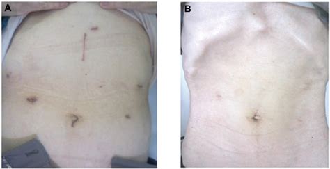 Figure 1 From Efficacy Of Totally Laparoscopic Distal Gastrectomy For