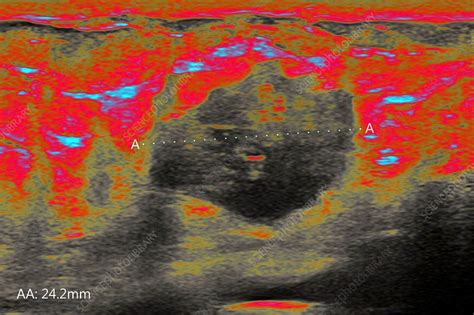 Breast Cancer Ultrasound Scan Stock Image C0390157 Science