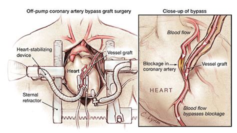 Coronary Artery Bypass Grafting Cardiothoracic Surgery