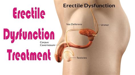 Erectile Dysfunction Treatment Best Ways To Treat Erectile Dysfunction Naturally YouTube