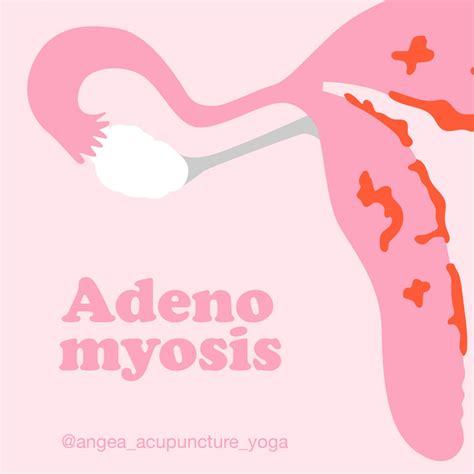 Adenomyosis And The Function Of Your Uterus Angea