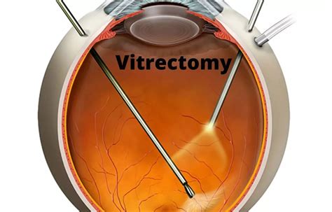 Pars Plana Vitrectomy Improves Retinal Reattachment But Not Visual