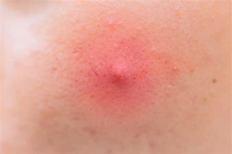 Pimple Under My Armpit