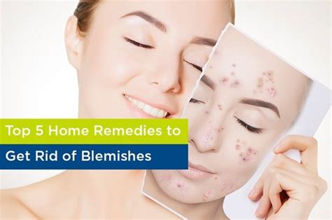 Top 5 Home Remedies To Get Rid Of Blemishes Wellness Info