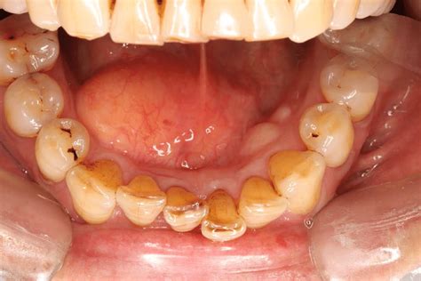 Intraoral Examination Showed A Mass Located In The Floor Of Mouth A