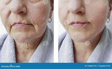 Elderly Woman Wrinkles Face Before And After Procedures Effect Stock