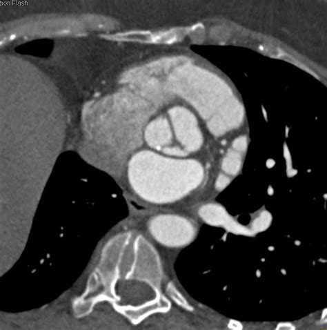 Bicuspid Aortic Valve With Dilated Ascending Aorta Cardiac Case