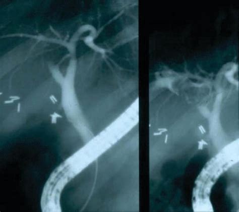 Ercp Management Of Complicated Stone Disease Of The Bile Duct And