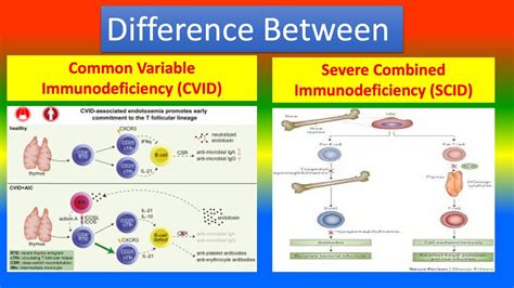 Distinctions Common Variable Immunodeficiency Cvid And Severe