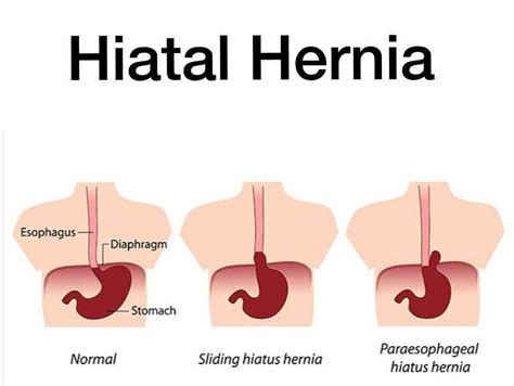 Hiatal Hernia Surgery Procedure And Recovery Dr Abhijit Gotkhinde