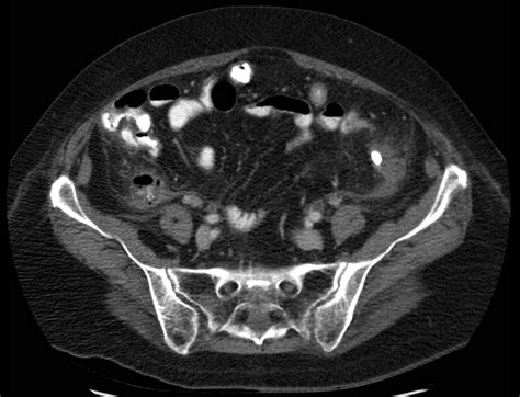 Perforated Appendicitis On Ct Radrounds Radiology Network