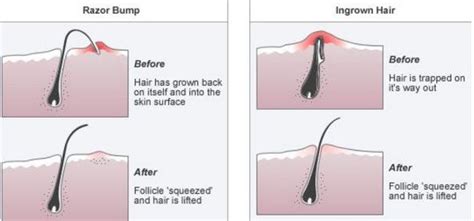 Ingrown Hair Cyst Pictures Removal Treatment Causes Symptom