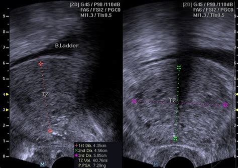 Transrectal Ultrasound Of The Prostate Showing Measurement Of The