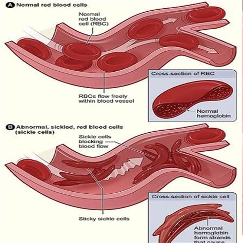 Anemia mediterránea — anemia hemolítica caracterizada por hematíes microcíticos, hipocrómicos y de vida corta, causada por una síntesis deficiente de hemoglobina deficiente. Anemia Falciforme: cos'è, le cause e le cure migliori | Anemia Mediterranea.it