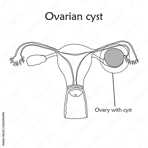 Ovarian Cyst Human Realistic Uterus Anatomy Flat Illustration With