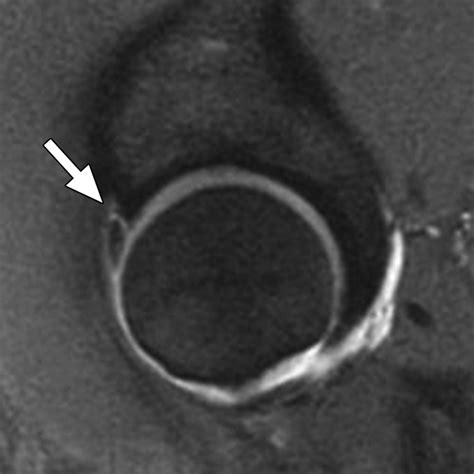 Mr Arthrographic Appearance Of The Postoperative Acetabular Labrum In