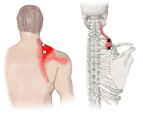 Levator Scapulae Muscle Function Trigger Points And Anatomy Images