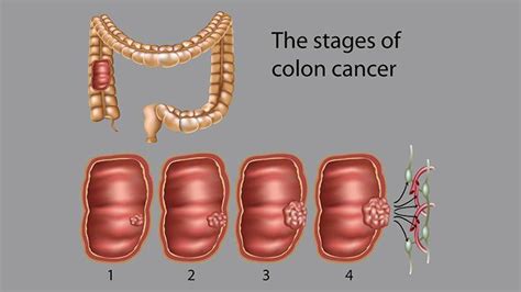 Colon Cancer Stages What Do They Mean For Survival Everyday Health