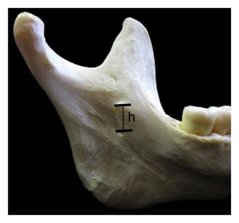 Medial View Of The Ramus Of Mandible A Illustration Of The Height Of