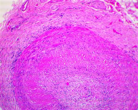 Large Vessel Vasculitis Giant Cell Arteritis And Takayasu Arteritis