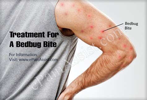 Bedbug Bite Treatment Prevention Ways To Get Rid Of Bed Bugs