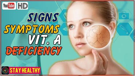 8 Signs And Symptoms Of Vitamin A Deficiency Youtube
