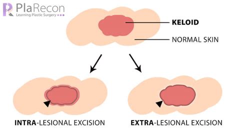 Keloid Management Prevention And Treatment