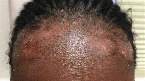 Seborrheic Dermatitis Of The Face And Scalp In Skin Of 43 Off