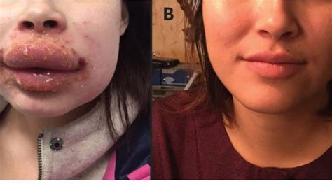 Womans Swollen Lips Traced To Severe Polysporin Ointment Allergy Cbc
