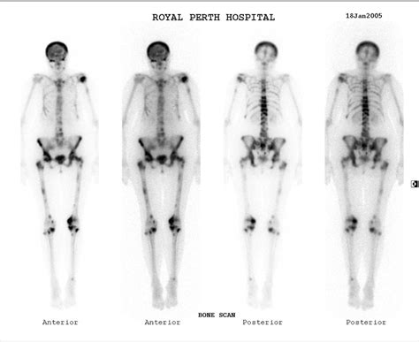 Maybe you would like to learn more about one of these? Bone Metastases